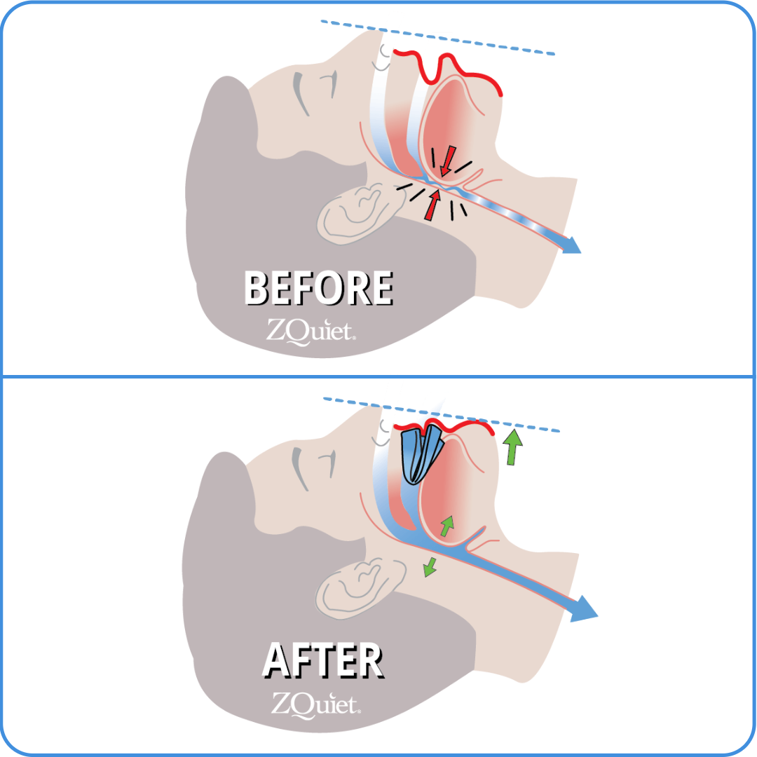 Two illustrations showing the root cause of snoring with the airway collapse in the back of the throat, and a clear airway and no snoring using a ZQuiet anti-snoring mouthpiece.