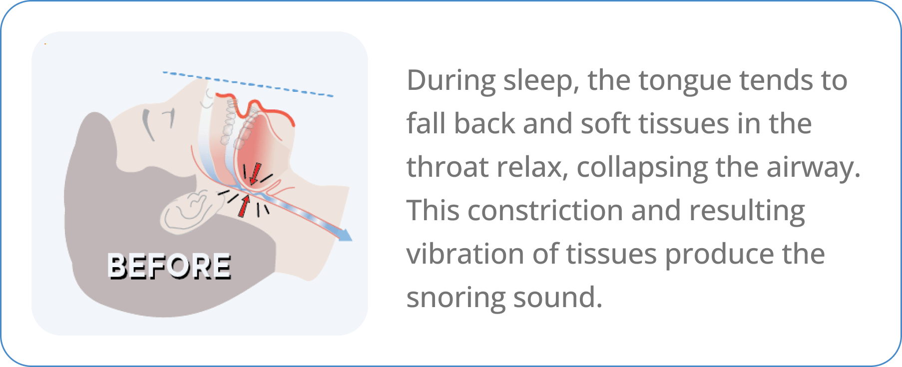 Before illustration showing the root cause of snoring when the airway collapses during sleep and tissues vibrate to make the snoring sound