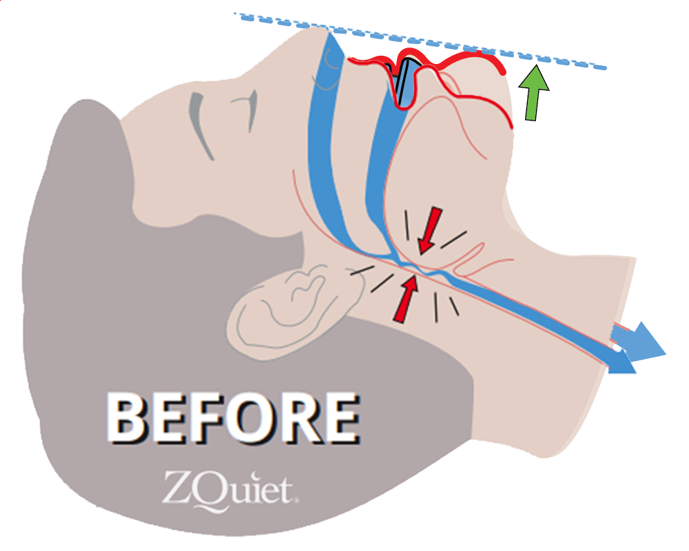 Illustration of a compromised airway with snoring 