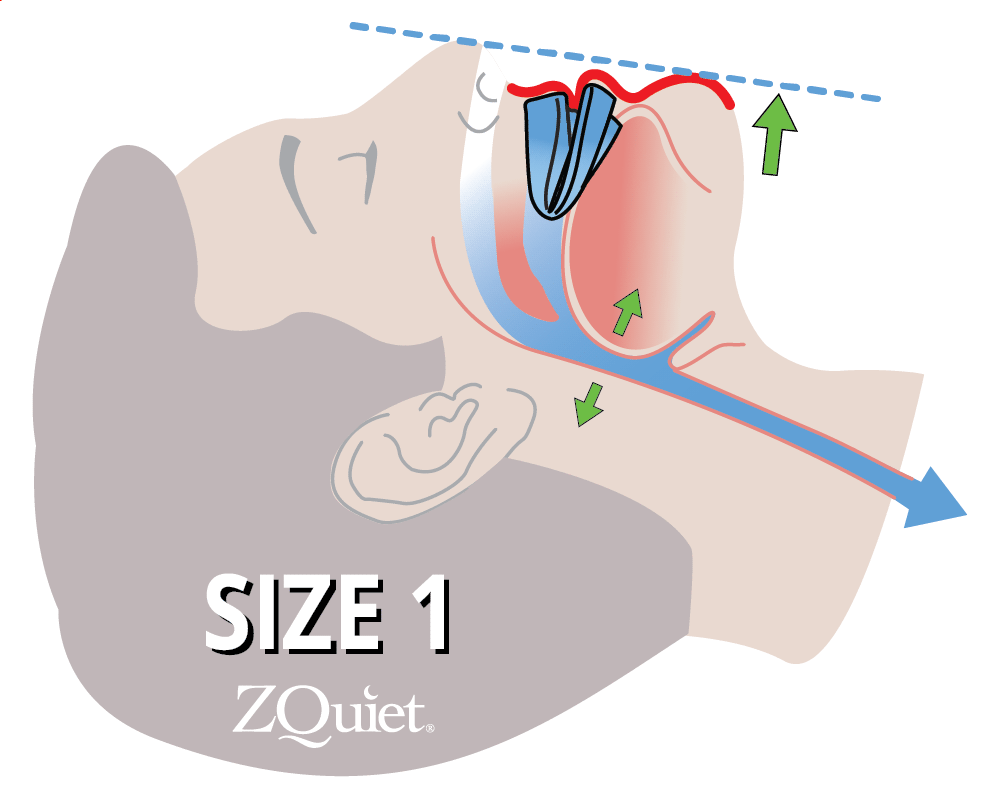 illustration showing how ZQuiet advances the jaw to keep the airway open and stop the snoring sound