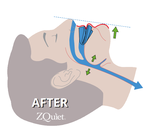 illustration showing how ZQuiet advances the jaw to keep the airway open and stop the snoring sound