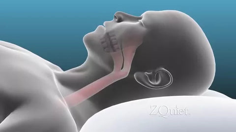 ZQuiet Anti-Snoring Mouthpiece 2-Size Starter Pack