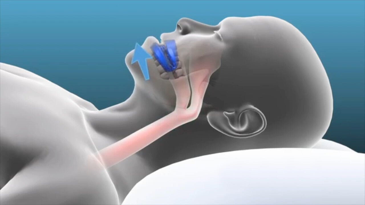 Mandibular Advance Devices