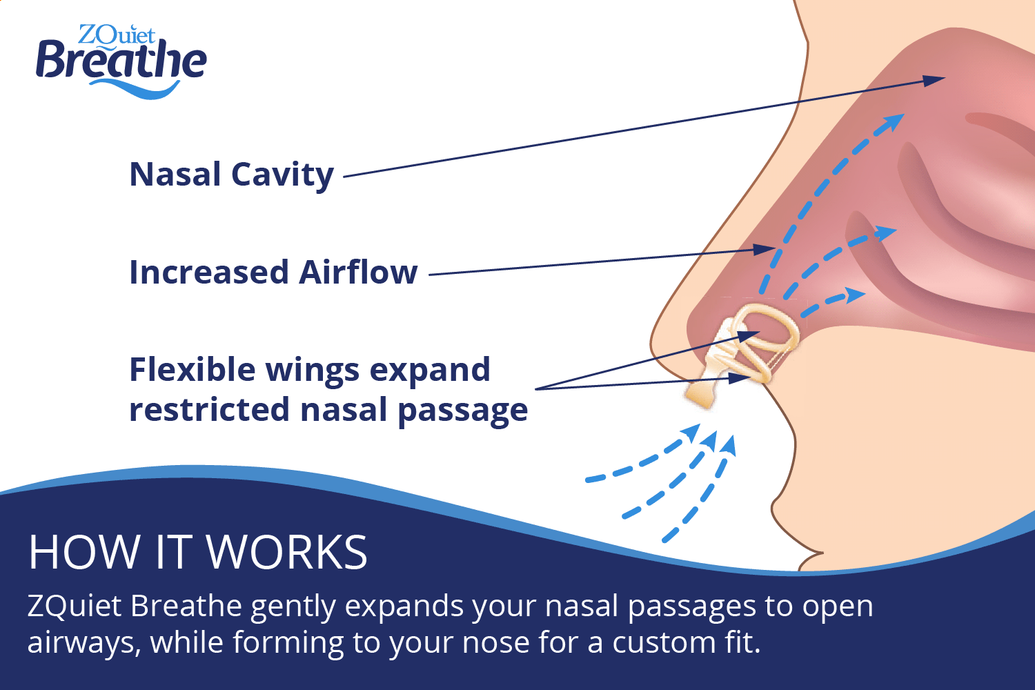 illustration showing how ZQuiet breathe works to expand nasal passages to increase airflow