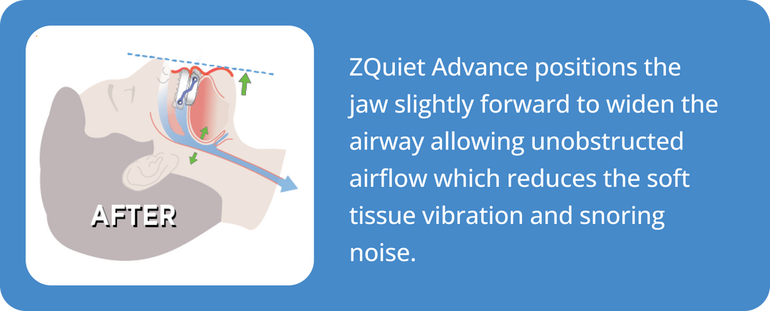Advance Anti-Snoring Mouthpiece | Custom Snoring Mouthguard | ZQuiet