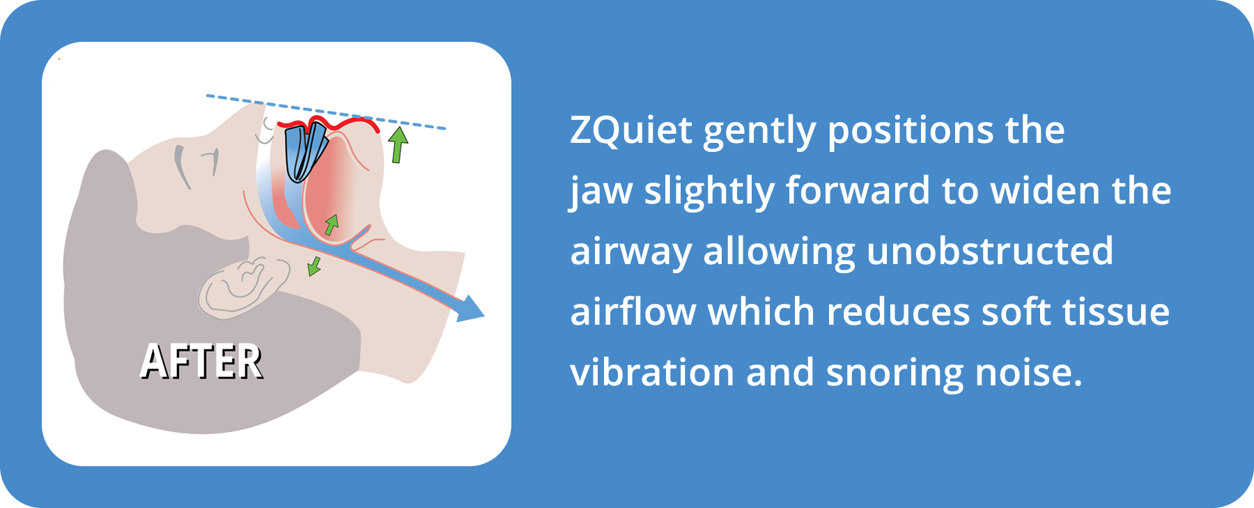 illustration showing clear airway and no snoring with ZQuiet mouthpiece and text description of how it works