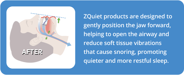 illustration showing clear airway and no snoring with ZQuiet Advance mouthpiece