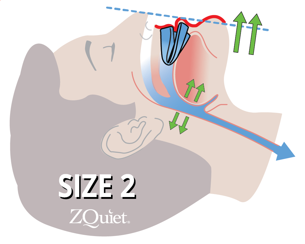 Illustration showing the Size 2 ZQuiet mouthpiece advancing jaw to widen airway and prevent snoring noise