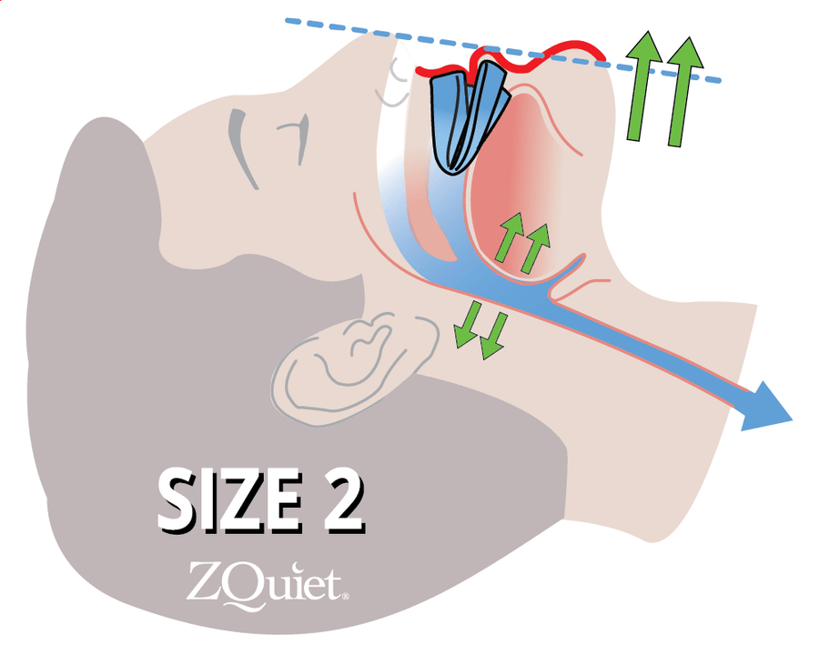 Size 2 advances jaw further to keep the airway open