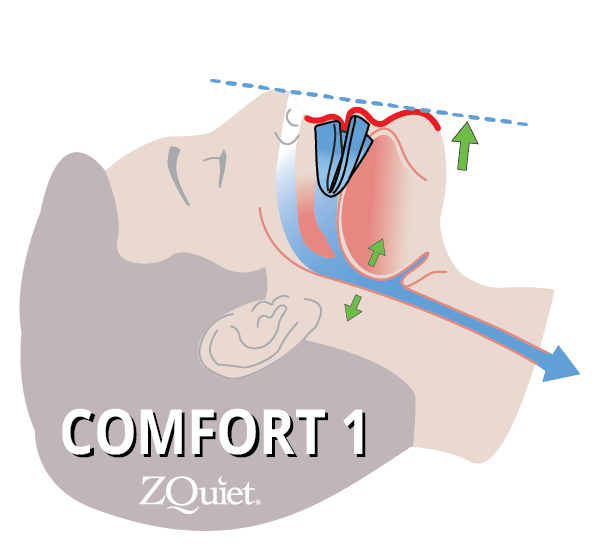 illustration showing how size 1 advances the jaw to keep the airway open and stop the snoring sound