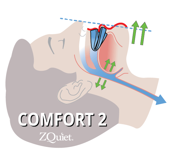 illustration showing how size 2 advances jaw a little bit further to keep the airway open and stop the snoring sound