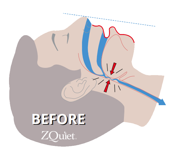 illustration showing the root cause of snoring in airway without ZQuiet anti-snoring mouthpiece