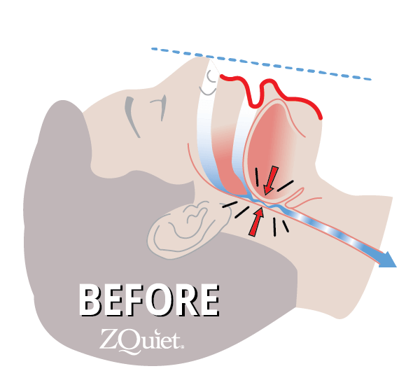 illustration showing the root cause of snoring in airway without ZQuiet anti-snoring mouthpiece